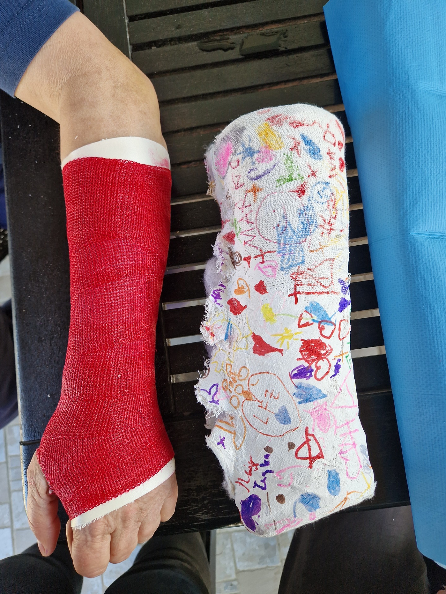 Gips Ruka Plastični gips :: plastični.gips