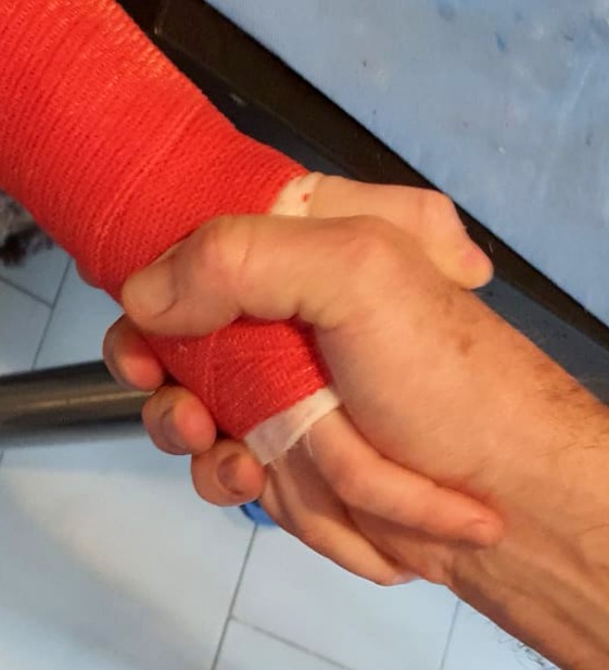 Gips Ruka Plastični gips :: plastični.gips